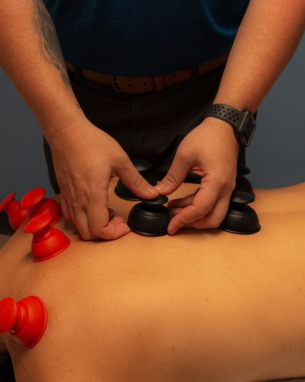 Sports chiropractor in bellingham applying cupping therapy to a patients back to help relax tight muscles and relieve back pain and headaches